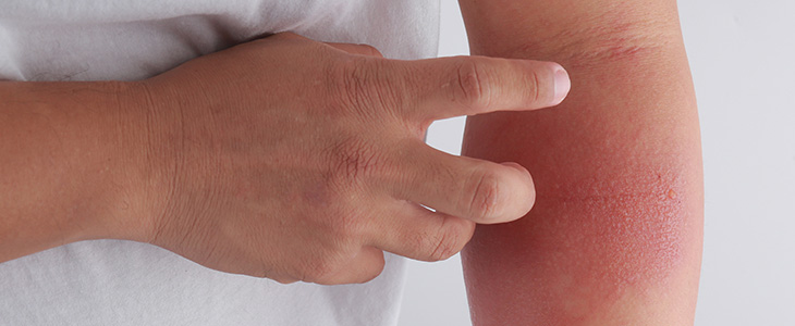 Dermatite atópica: o que é e como tratar?