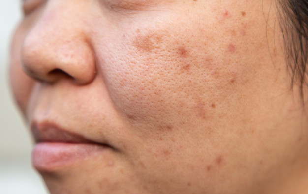 079 – Pesquisa com sérum facial para mancha pós gravidez