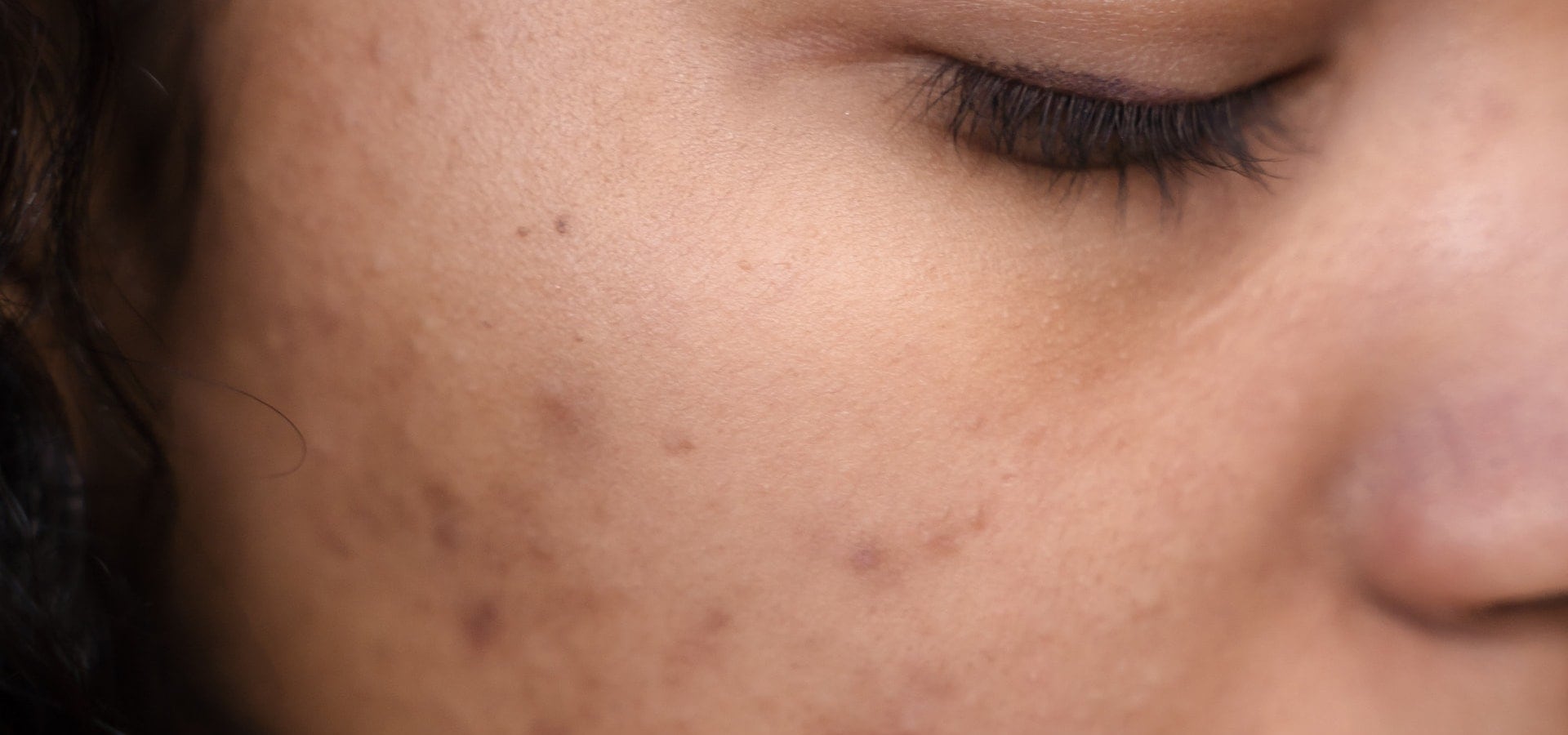 097 – Pesquisa com cosmético clareador de manchas 