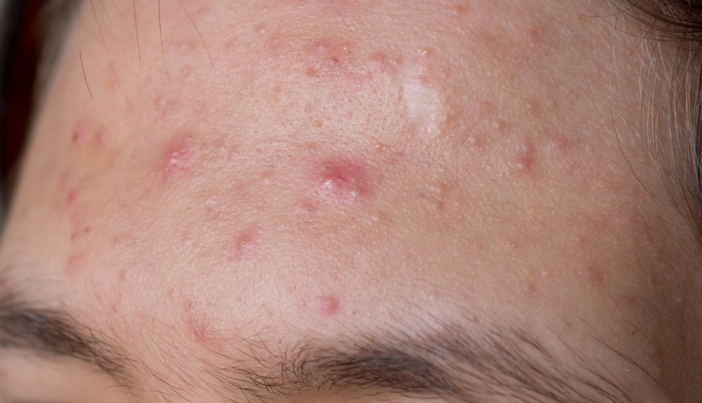 082 – Pesquisa com cosméticos para redução de espinhas e melhora das manchas de acne