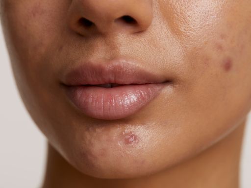 008- Pesquisa com cleanser facial para redução de manchas de espinha