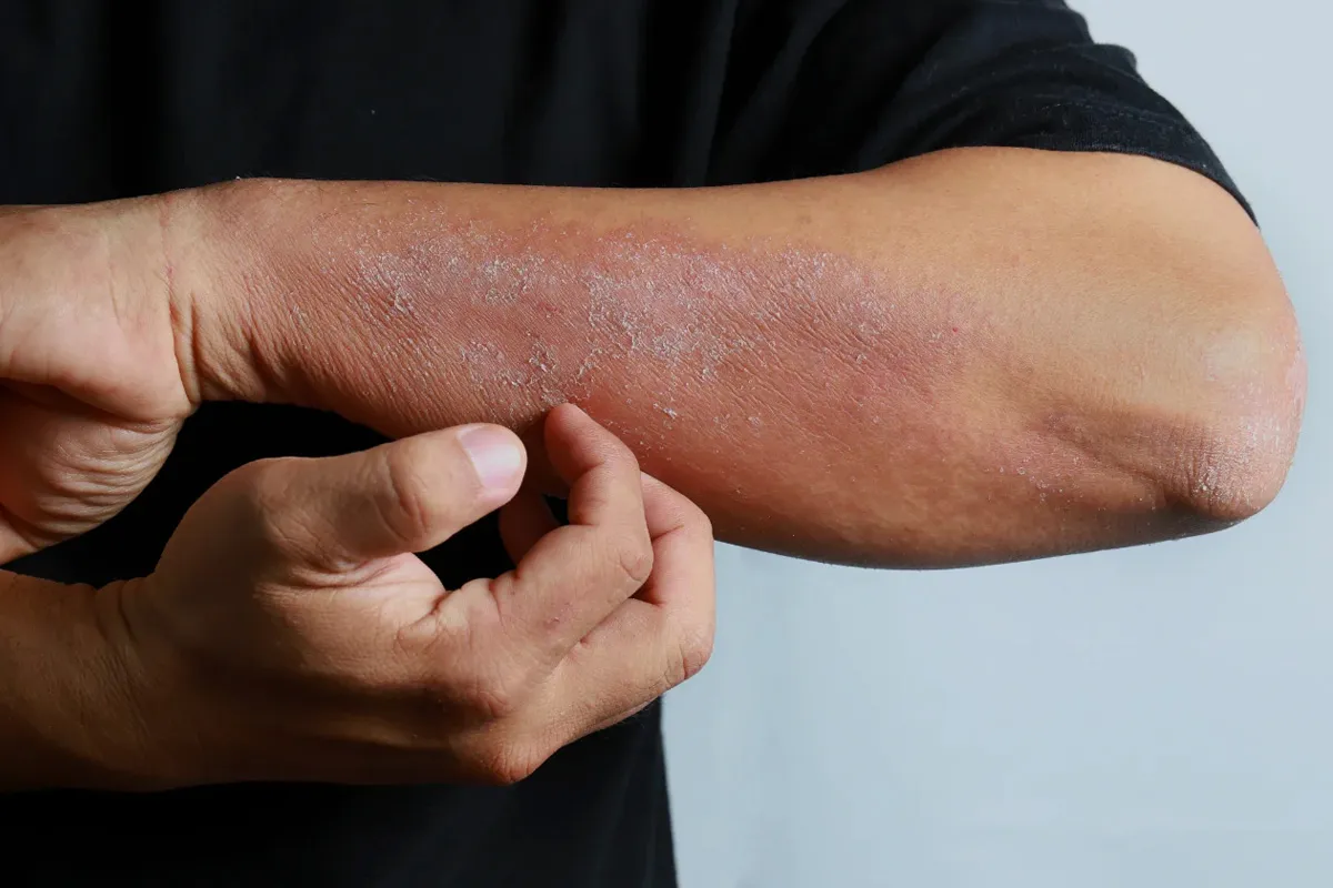 018 – Pesquisa com hidratante para o cuidado da pele com dermatite atópica